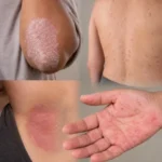 Diferentes tipos de Psoriasis