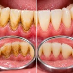 Sarro dental causas y soluciones